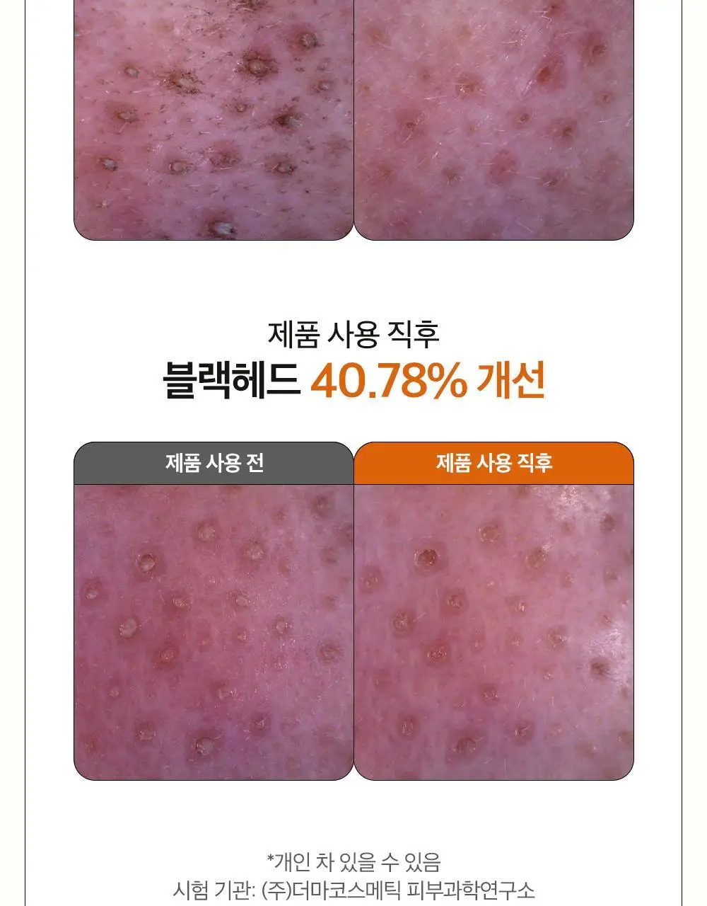 [블랙헤드 지우개] 파파레서피 블레미쉬 클렌징 오일 300ml 상세페이지 11